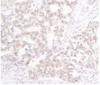 Immunohistochemistry-Paraffin: EZH2/KMT6 [p Ser21] Antibody [NBP1-18935] - FFPE section of human lung carcinoma. Antibody: Affinity purified rabbit antiPhospho-EZH2 (S21) used at a dilution of 1:250. Detection:DAB